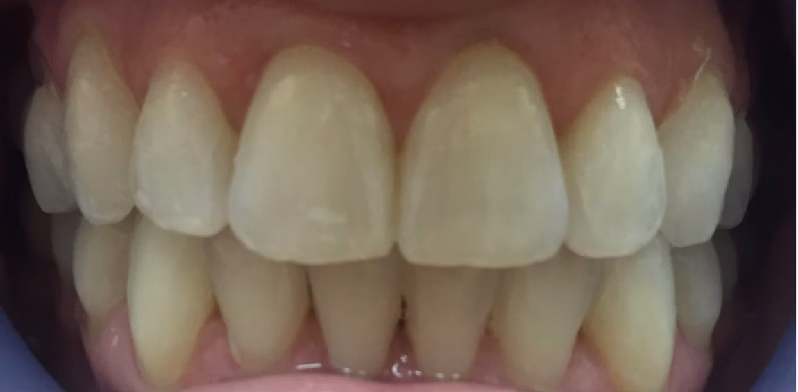 108236-Invisalign.jpg