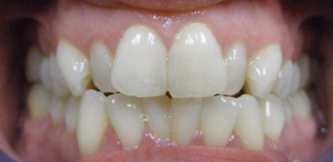 108236-Invisalign.jpg